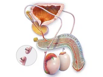 Male Contraception in NZ: Why Vasectomy Is Becoming More Popular